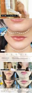 怎么修图下巴变宽_下巴宽度调整，美图秀秀甜盐相机助你自然变美