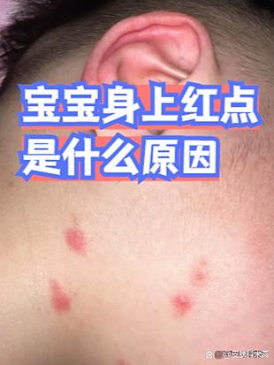 宝宝拍照红点点在哪_可能是痤疮尿布疹或过敏
