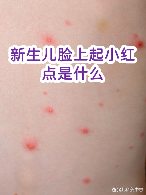 宝宝拍照红点点在哪_可能是痤疮尿布疹或过敏
