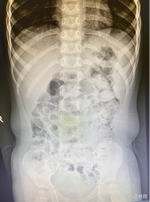 腹部立位前后位摄影参数_腹部立位前后位摄影标准化操作要点