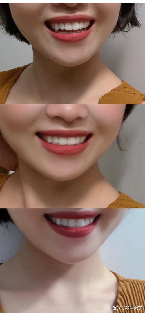 牙齿美白后的照片_小杨牙齿发黄专业美白自信笑容