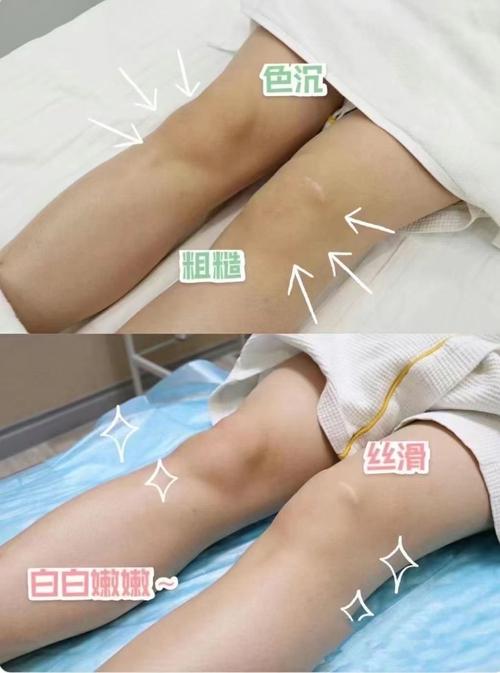 全身美白对比高清图_角质厚难美白？先去角质，选对精华！