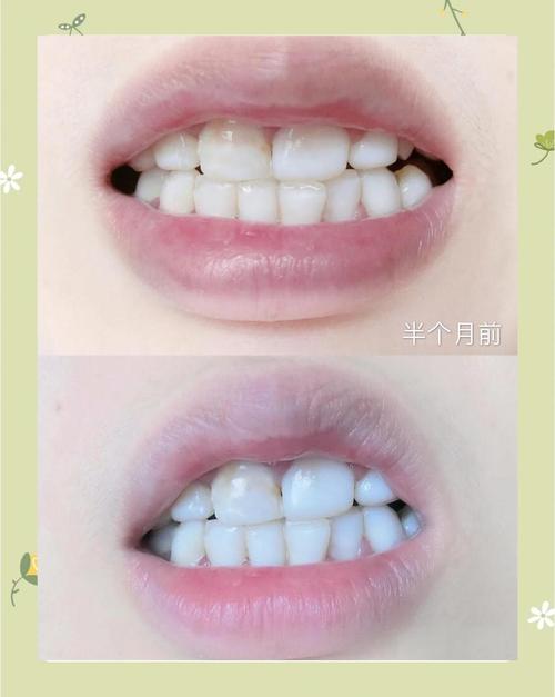 牙齿美白真实对比图_冷光美白效果真不错，牙渍洗掉笑更自信！