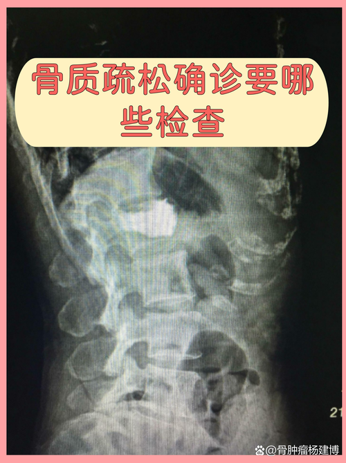x线拍摄部位参数表_找准位置选对电压距离，用滤线器减散光